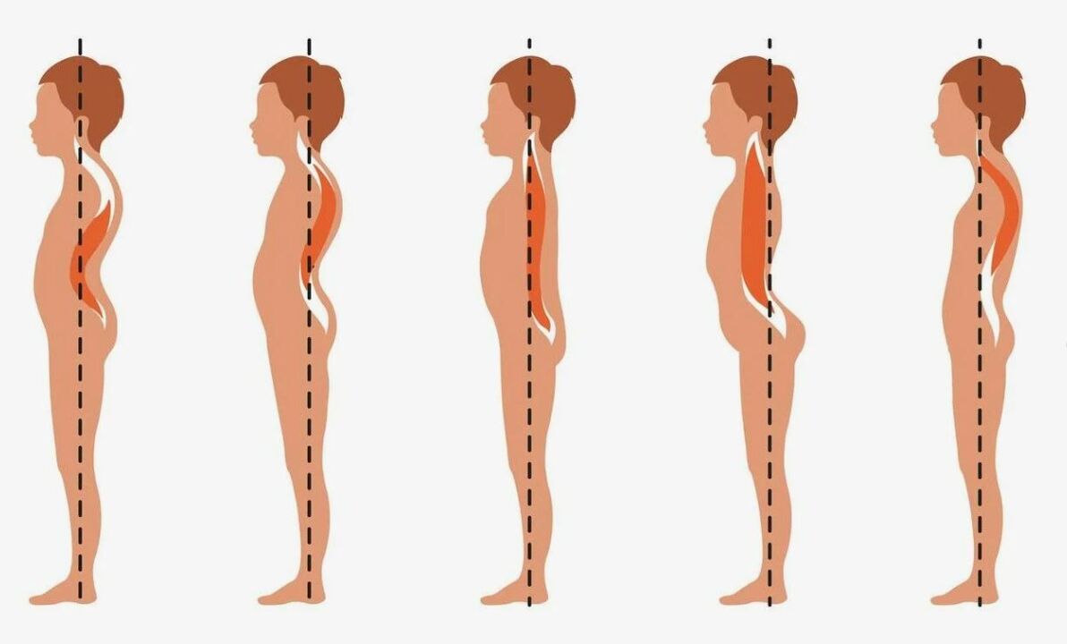 grau de desenvolvimento da osteocondrose lombar