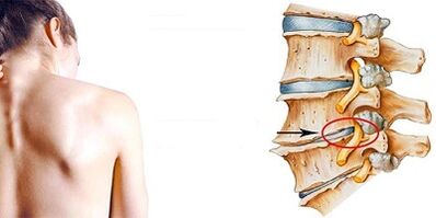 O mecanismo de desenvolvimento da osteocondrose cervical