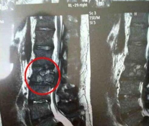 O tumor da coluna na foto