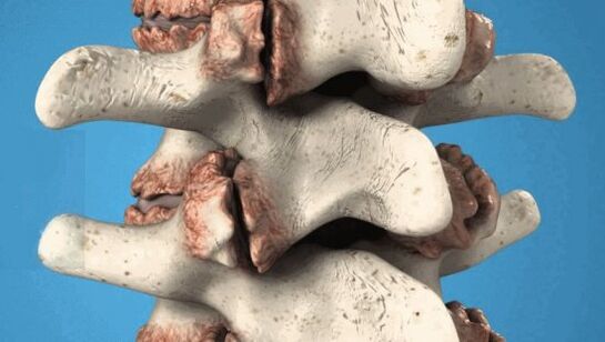 Osteófitos das vértebras - crescimentos patológicos que danificam os nervos e os vasos sanguíneos