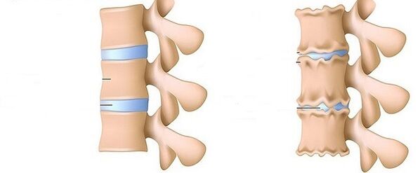 Coluna saudável e osteocondrose