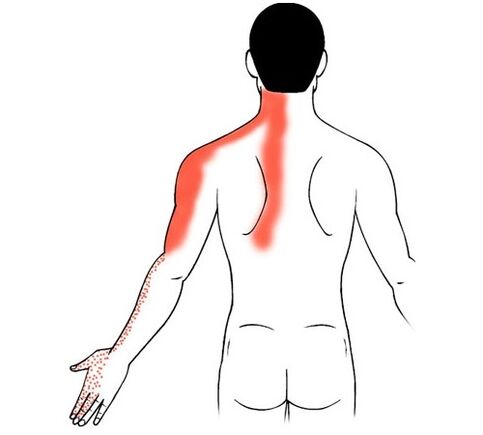 osteocondrose cervical como causa de dor nas articulações dos dedos