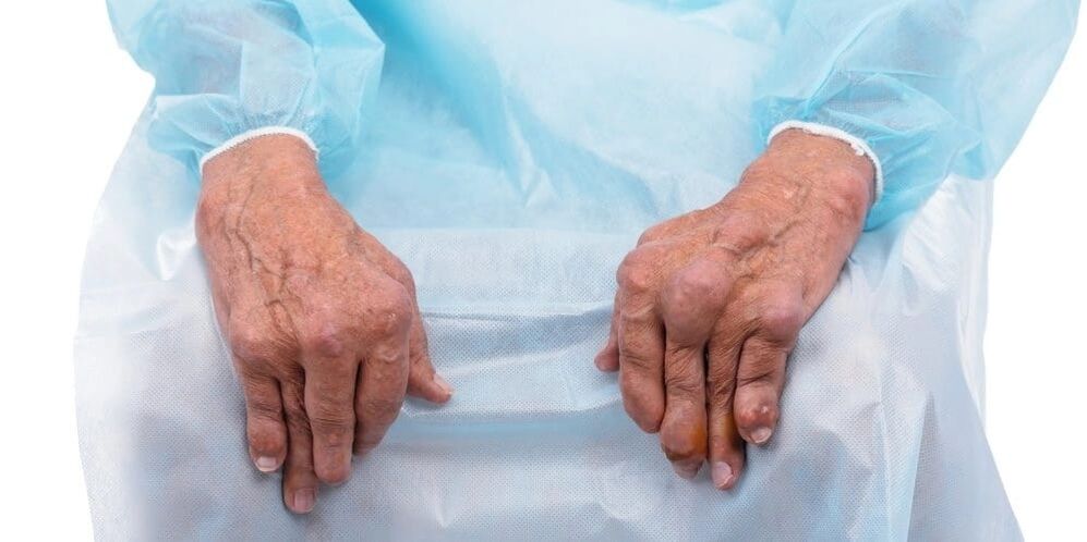 A artrite infecciosa é uma doença com dores constantes e alterações nas articulações dos dedos.