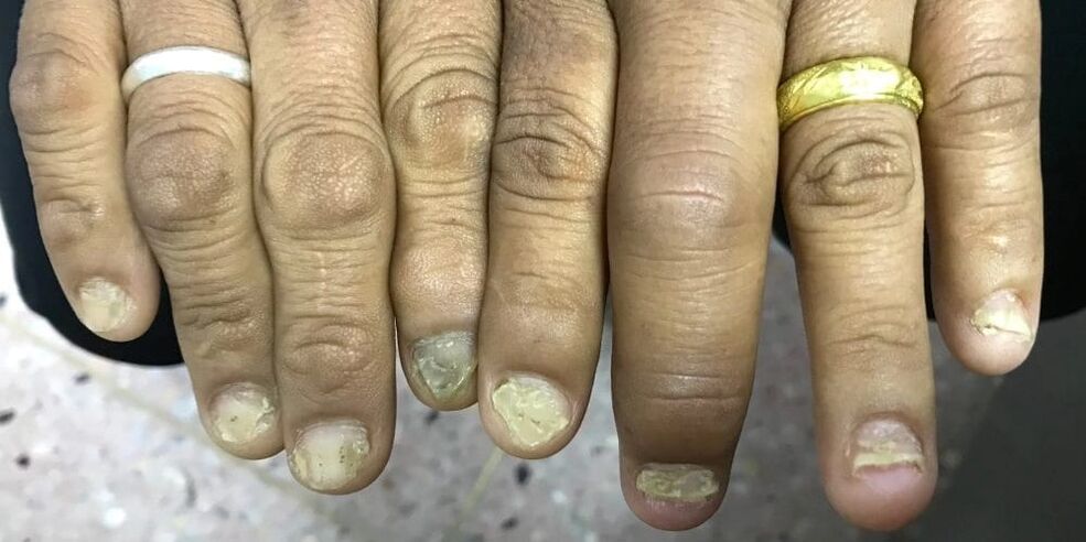 Inchaço dos dedos e deformação da lâmina ungueal podem indicar o desenvolvimento de artrite psoriática