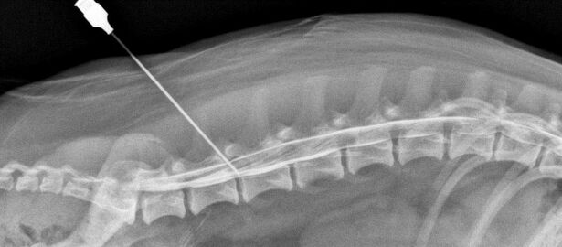 bloqueio da coluna vertebral com osteocondrose