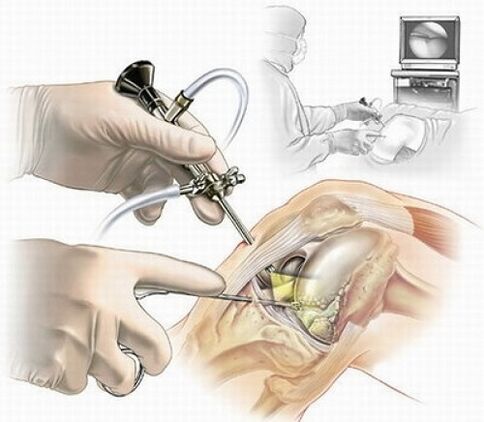 artroscopia do joelho para osteoartrite