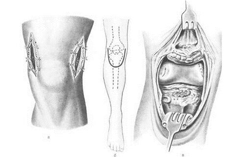 cirurgia de artrotomia para artrose